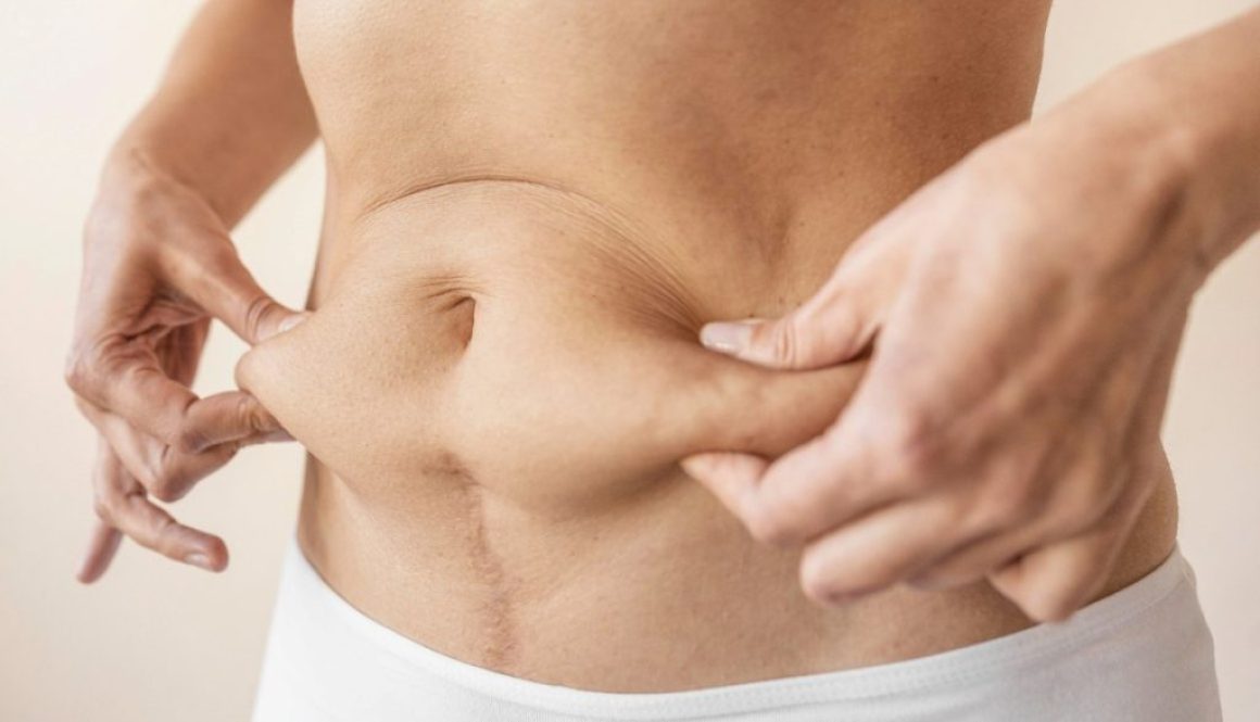 Abdominoplastia: o que é e quem pode fazer? Abdominoplastia: o que é e quem pode fazer?